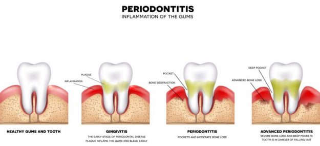 perio gum disease